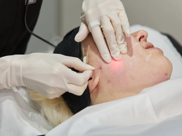 اندولیفت صورت چیست