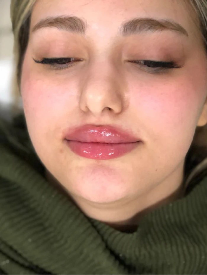 بهترین ژل برای تزریق به لب1