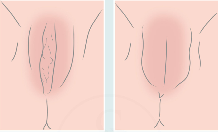 تزریق ژل به بیکینی چگونه است