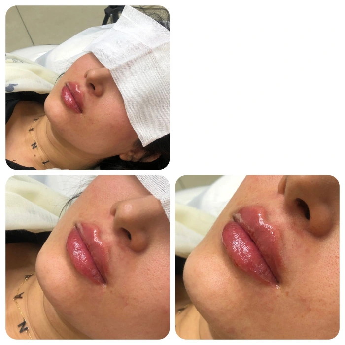 سوالات پرتکرار درباره ژل لب نورامیس