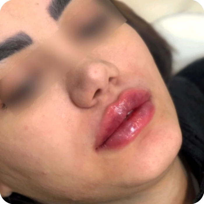 تزریق ژل نورامیس در کرج با قیمت مناسب+ انواع ژل نورامیس در کرج