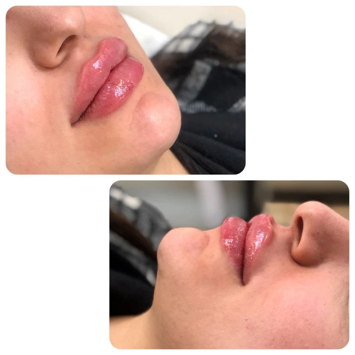 تزریق ژل نورامیس در کرج با قیمت مناسب