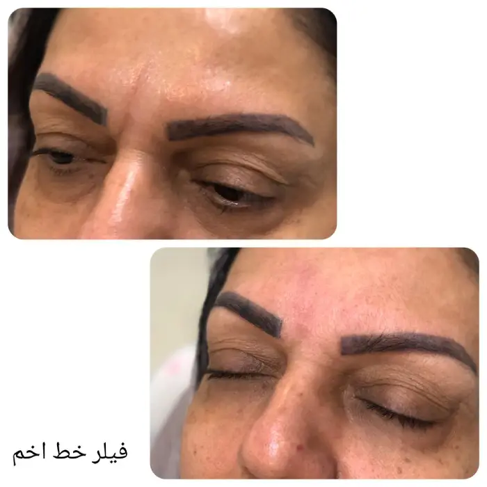 عوارض و محدودیت های تزریق ژل نورامیس