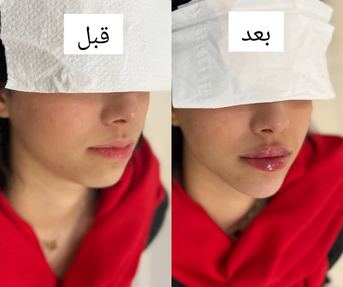 عوارض کوتاهمدت کانتورینگ صورت