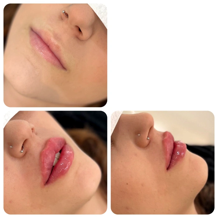 عکس ژل لب یک سی سی طبیعی و دخترانه