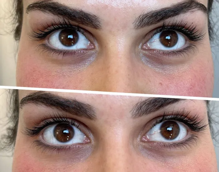 مراقبت های قبل از تزریق فیلر زیر چشم