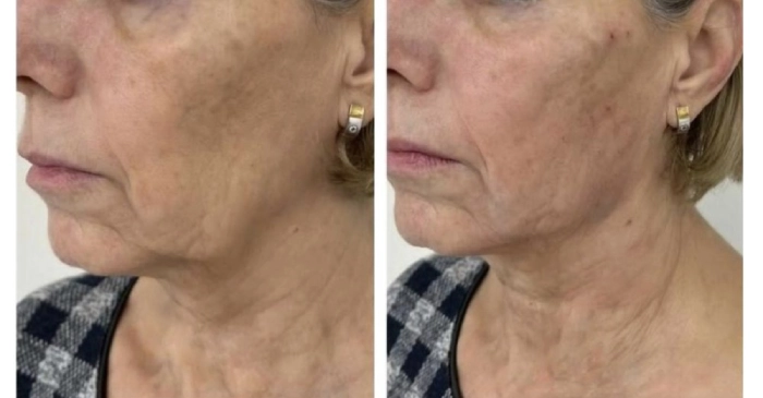 ماندگاری اندولیفت صورت