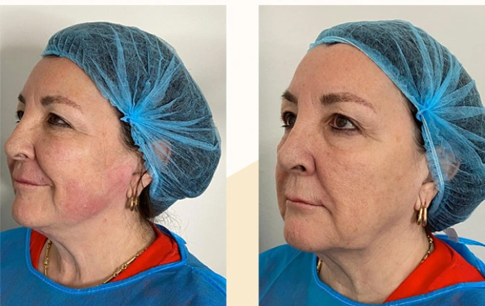 مراقبت های بعد از اندولیفت صورت