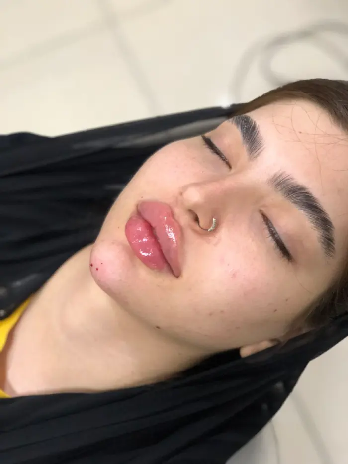 بهترین ژل برای تزریق به لب