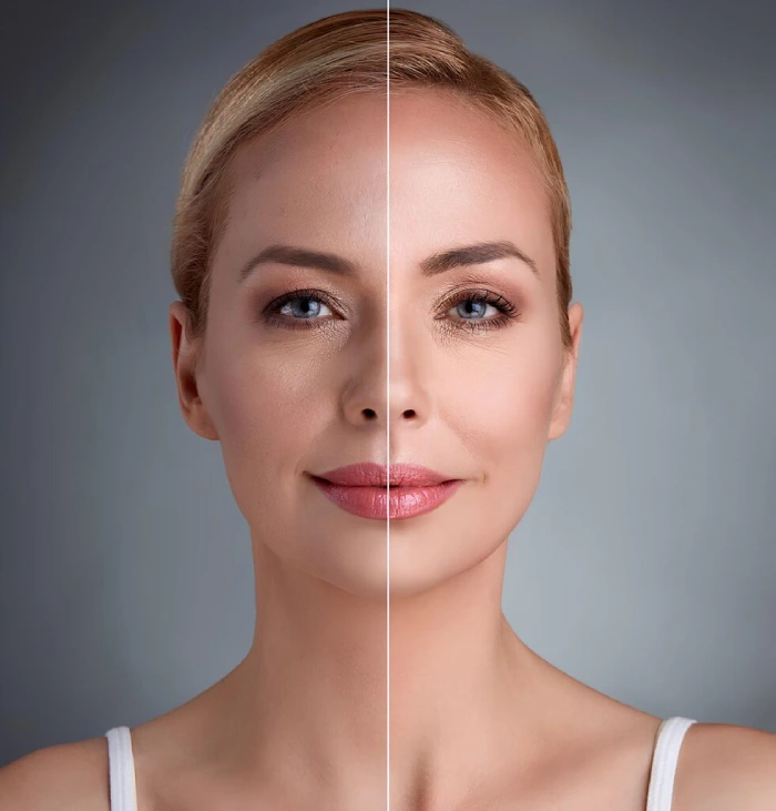 مراقبت های قبل از اندولیفت صورت