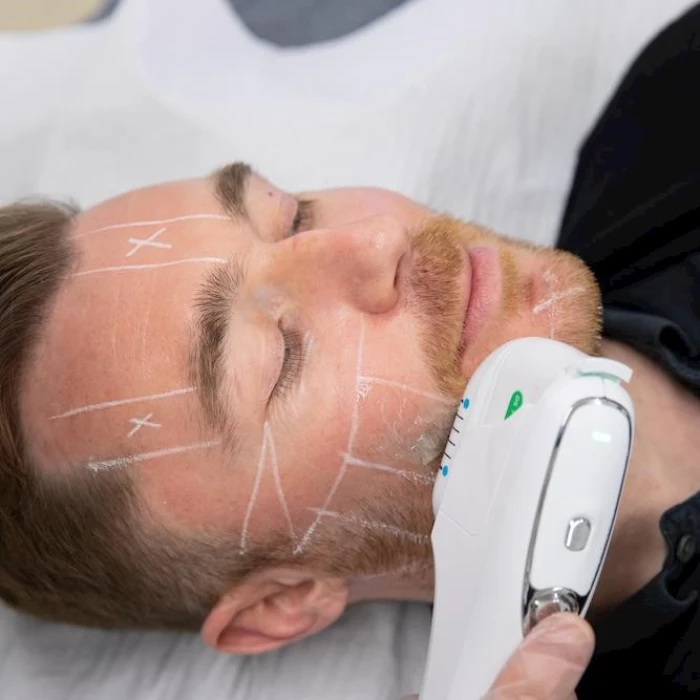 مراقبت های قبل از هایفوتراپی صورت