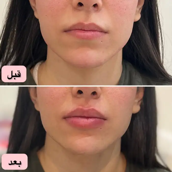 مراقبت‌های بعد از تزریق