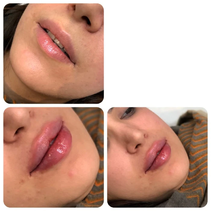 مقایسه ژل نورامیس و ژل رووفیل