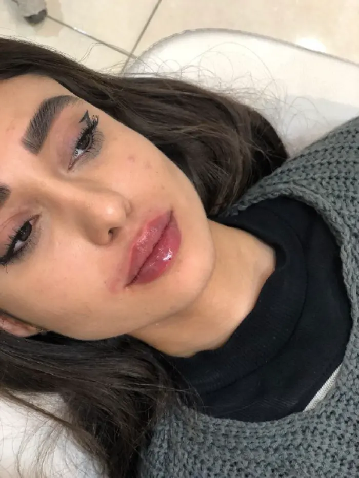 مهم ترین نکات که باید قبل از تزریق ژل لب بدانید