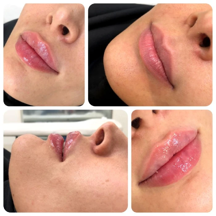 نکات مهم در انتخاب بهترین ژل برای تزریق به لب