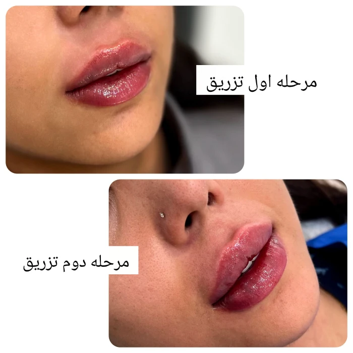 نکات مهم در تزریق ژل لب طبیعی دخترانه