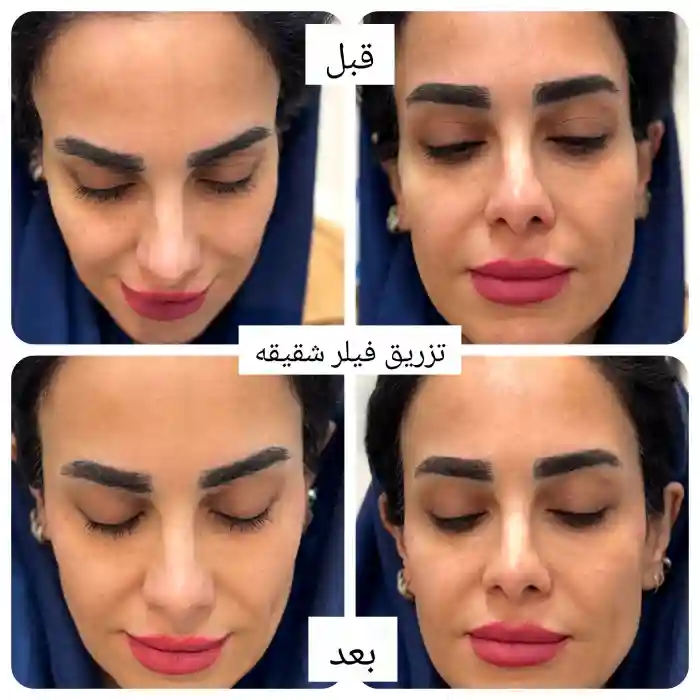 نکات مهم قبل و بعد از تزریق
