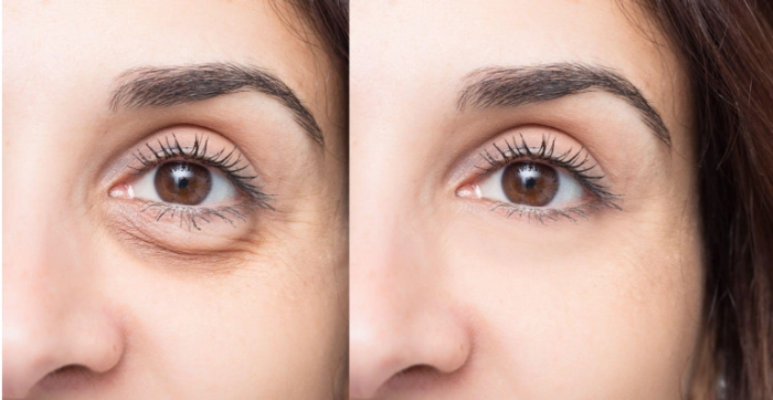 نکاتی برای انتخاب بهترین دکتر تزریق فیلر زیر چشم در کرج