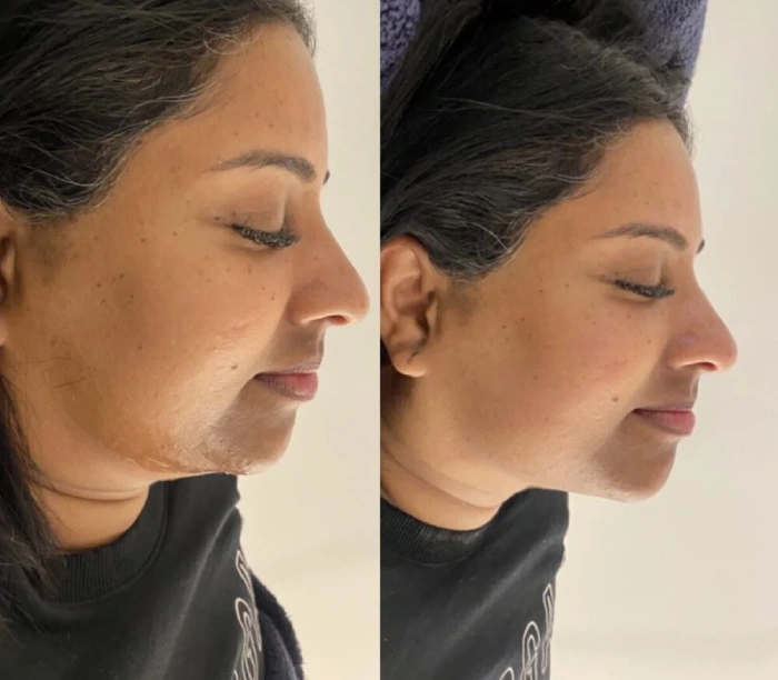 هایفوتراپی صورت در کرج