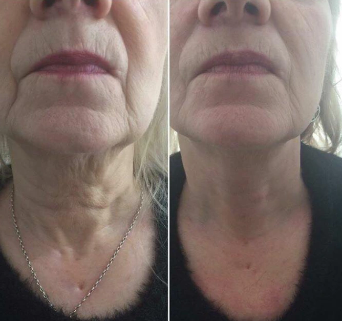 هایفوتراپی صورت در کرج