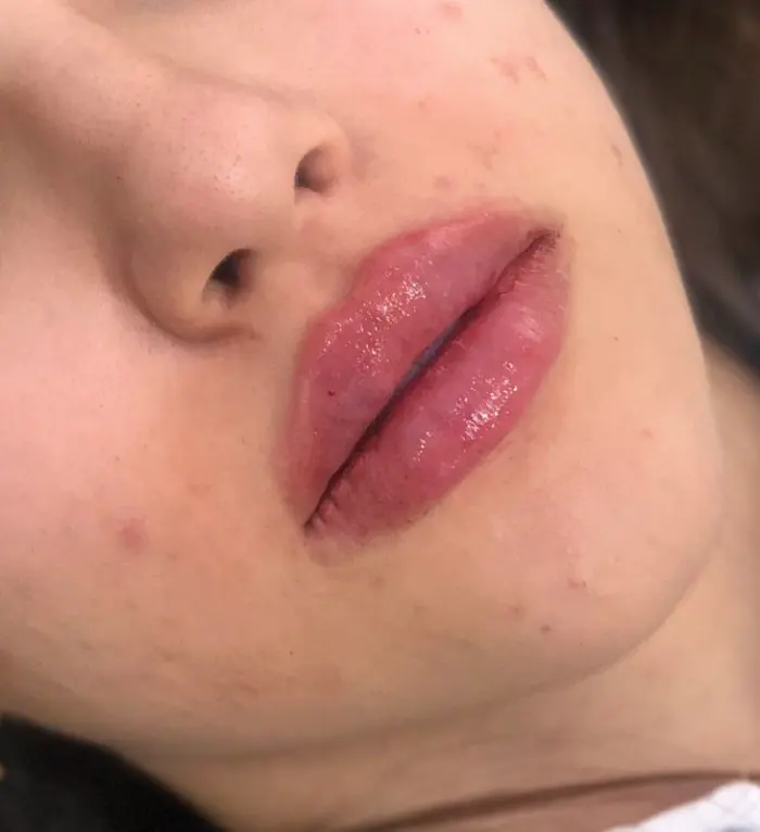 هزینه و قیمت تزریق ژل لب در کرج