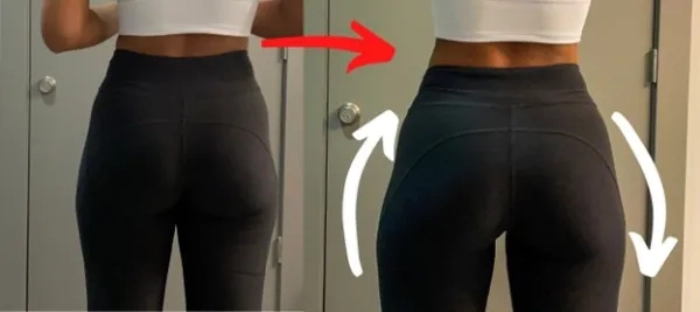 هزینه تزریق ژل به هیپ دیپ در کرج