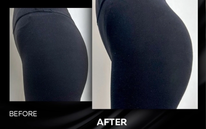 عوارض احتمالی تزریق ژل به هیپ دیپ در کرج