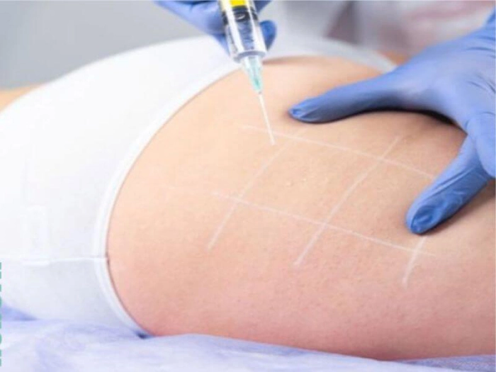 ماندگاری تزریق ژل به هیپ دیپ در کرج