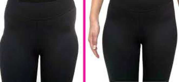 ماندگاری تزریق فیلر به هیپ دیپ در سنین مختلف