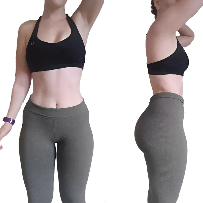 عوامل موثر بر ماندگاری تزریق فیلر به هیپ دیپ