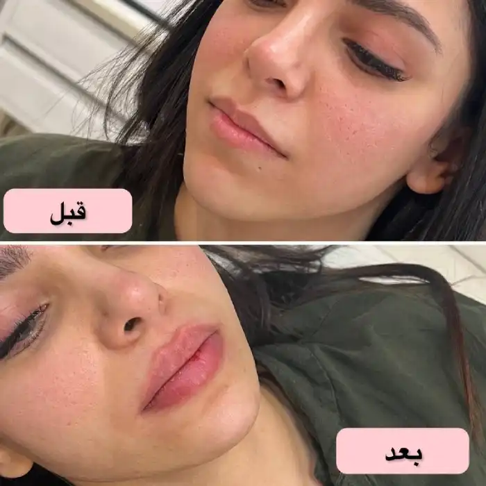 چرا ژل لب طبیعی برای دختران محبوب است؟