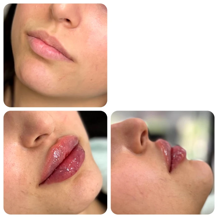 عوارض بلند مدت تزریق ژل لب