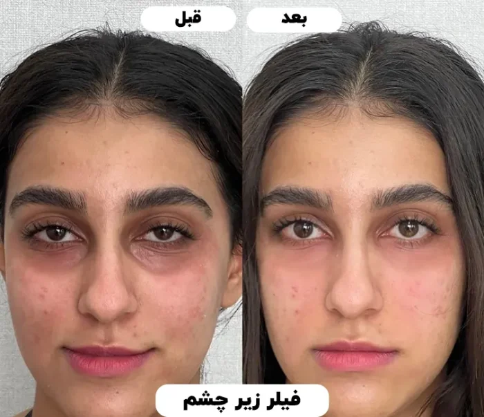 تزریق فیلر زیر چشم کرج