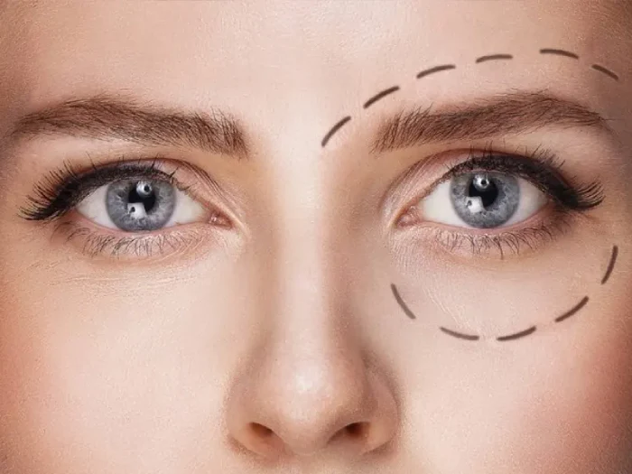 نکات مهم قبل از تزریق فیلر زیر چشم کرج