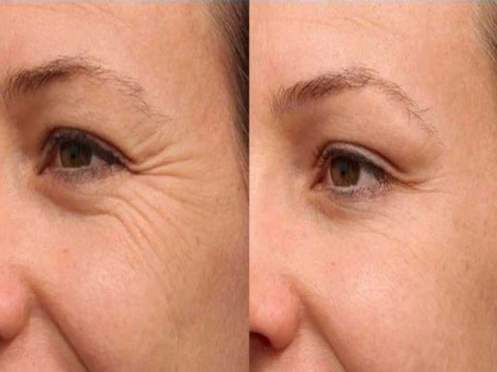 مراحل انجام تزریق فیلر زیر چشم