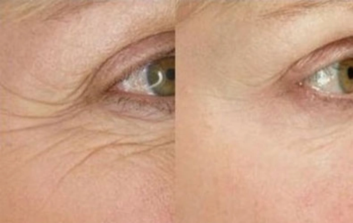 مراقبتهای بعد از تزریق فیلر زیر چشم