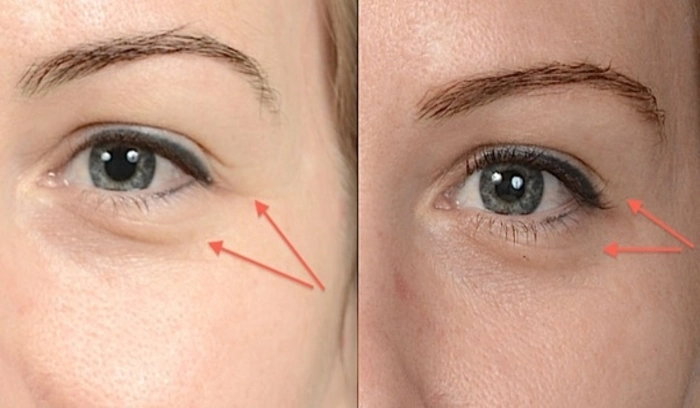 ماندگاری تزریق فیلر زیر چشم