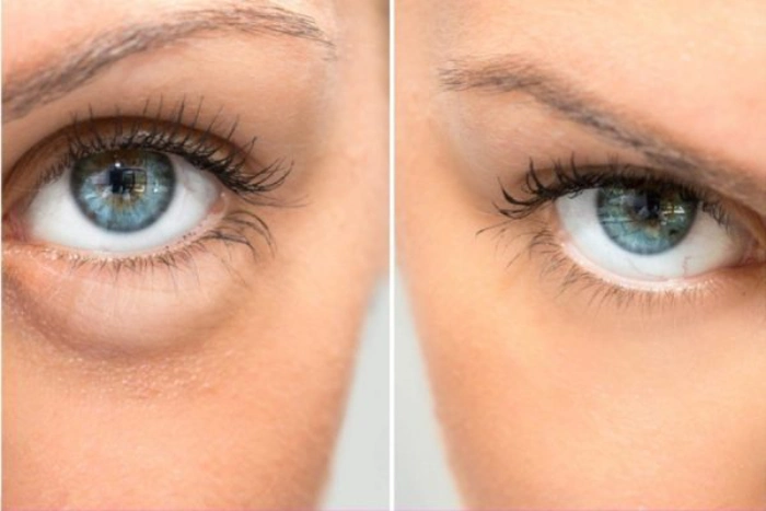 عوارض احتمالی تزریق فیلر زیر چشم