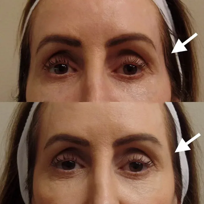 تزریق فیلر شقیقه کرج