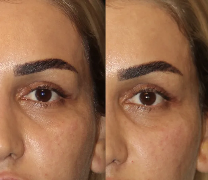 فرآیند تزریق فیلر شقیقه کرج