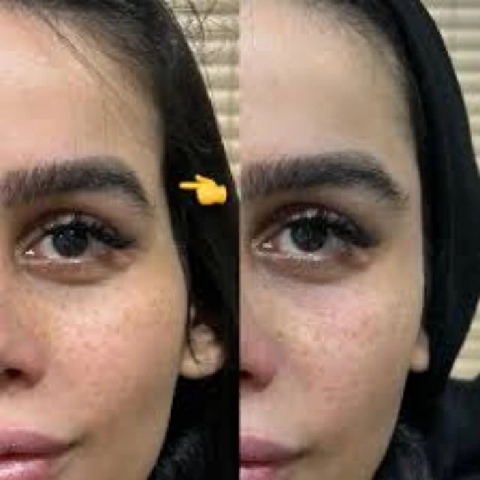 مزایای تزریق فیلر شقیقه کرج