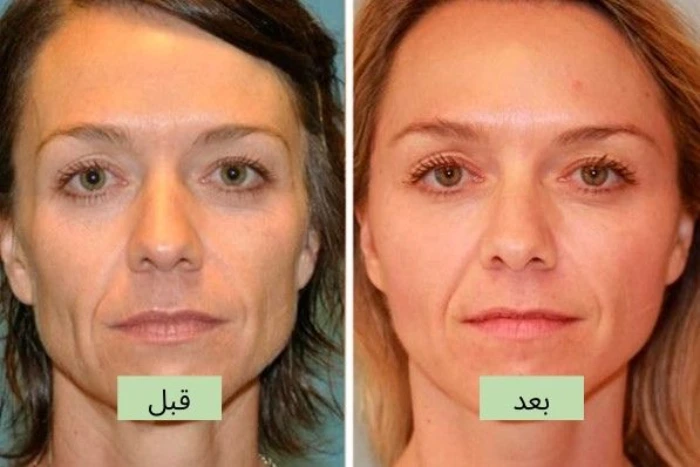 مراقبتهای بعد از تزریق فیلر شقیقه کرج