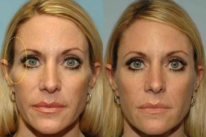 عوارض و نکات ایمنی تزریق فیلر شقیقه کرج