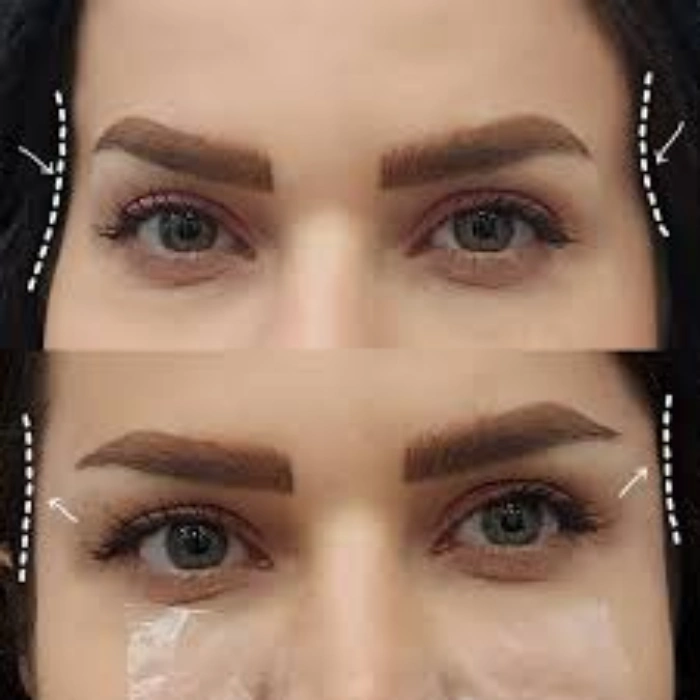 همه چیز درباره تزریق فیلر شقیقه کرج