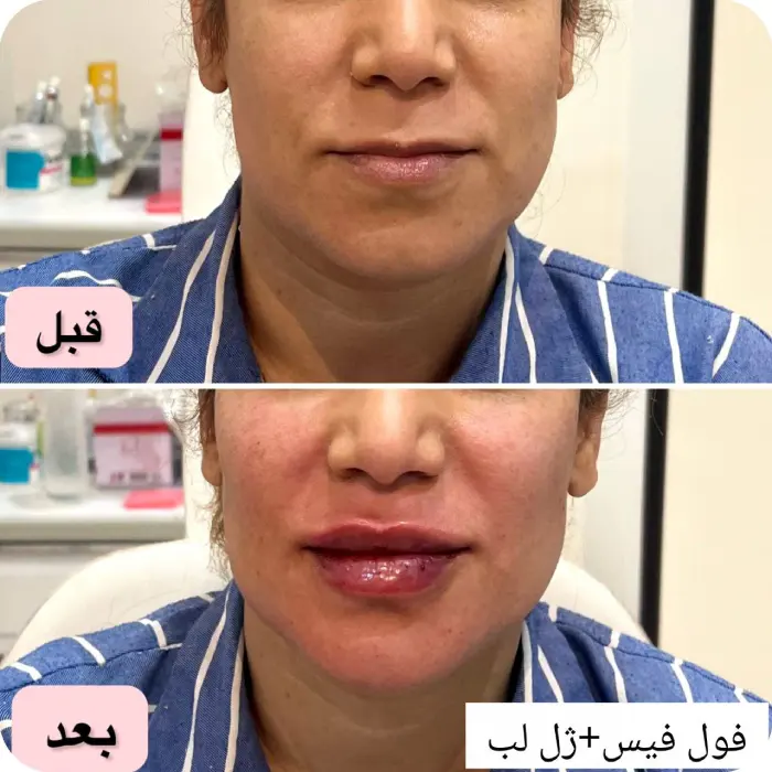 مزایا کانتورینگ فول فیس صورت با ژل و فیلر