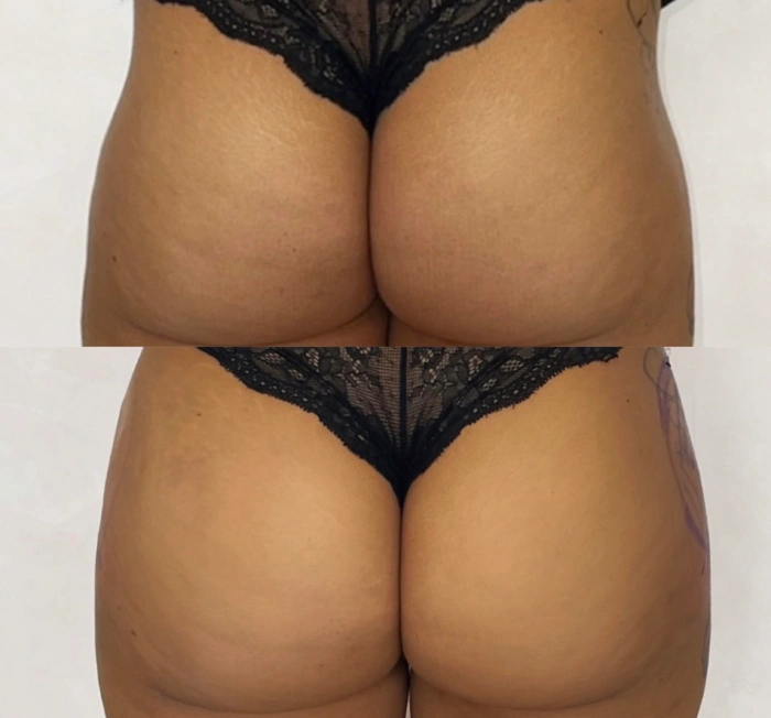 مزایای تزریق فیلر باسن: چرا به جای جراحی تزریق فیلر انجام دهیم؟