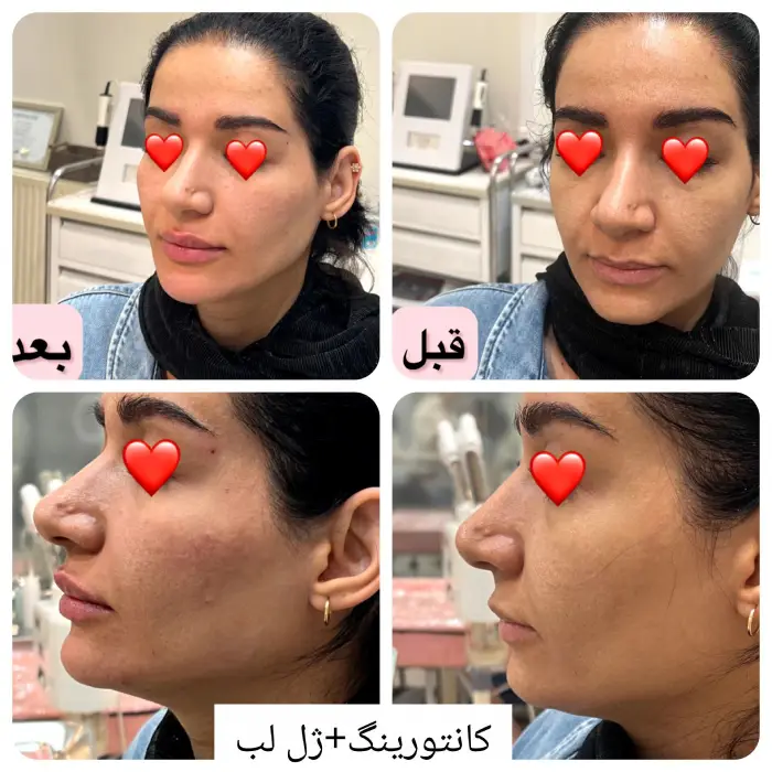 چگونه هزینه زاویه سازی صورت دائمی را کاهش دهیم؟