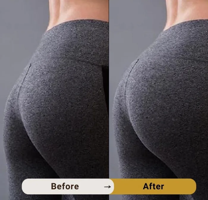 معایب تزریق فیلر باسن و خطرات احتمالی که ممکن است پیش آید