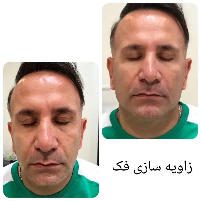 آیا زاویه سازی صورت با ژل درد دارد؟