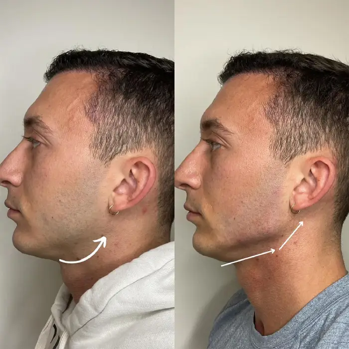 مدت ماندگاری زاویه سازی صورت با ژل